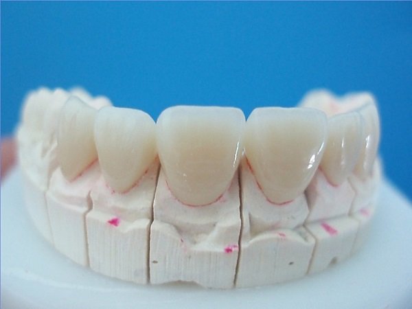 All-Ceramic-CrownBridge